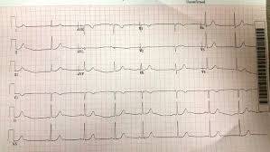 Ilustračné foto EKG.
