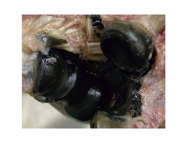 Alkaptonúria, alebo choroba čiernych kostí je spôsobená chýbaním funkčného enzýmu homogentisát-dioxygenázy v pečeni, čo vedie k ukladaniu čierneho pigmentu v chrupavkách a ich postupnému rozpadu