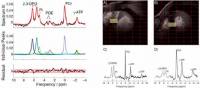 Metóda merania anorganického fosfátu a intracelulárneho pH v zdravom srdci a pri hypertrofickej kardiomyopatii za použitia kardiovaskulárnej magnetickej rezonancie